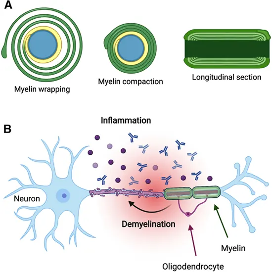 csf myelin basic protein